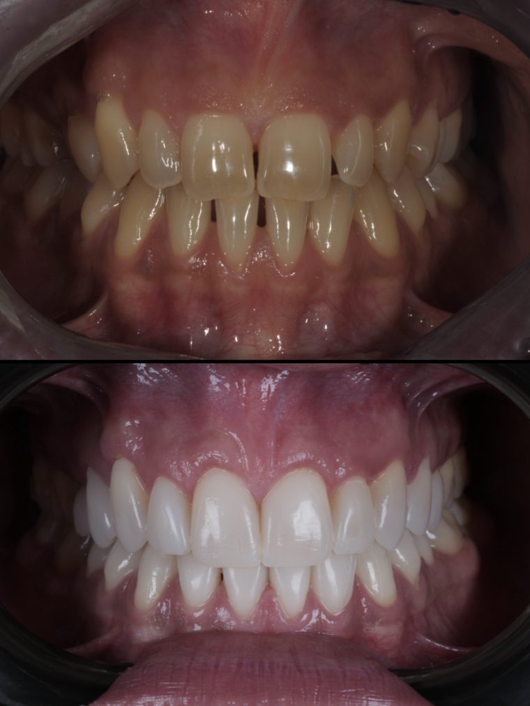 Caso clinico Flow Injection Technique: prima e dopo