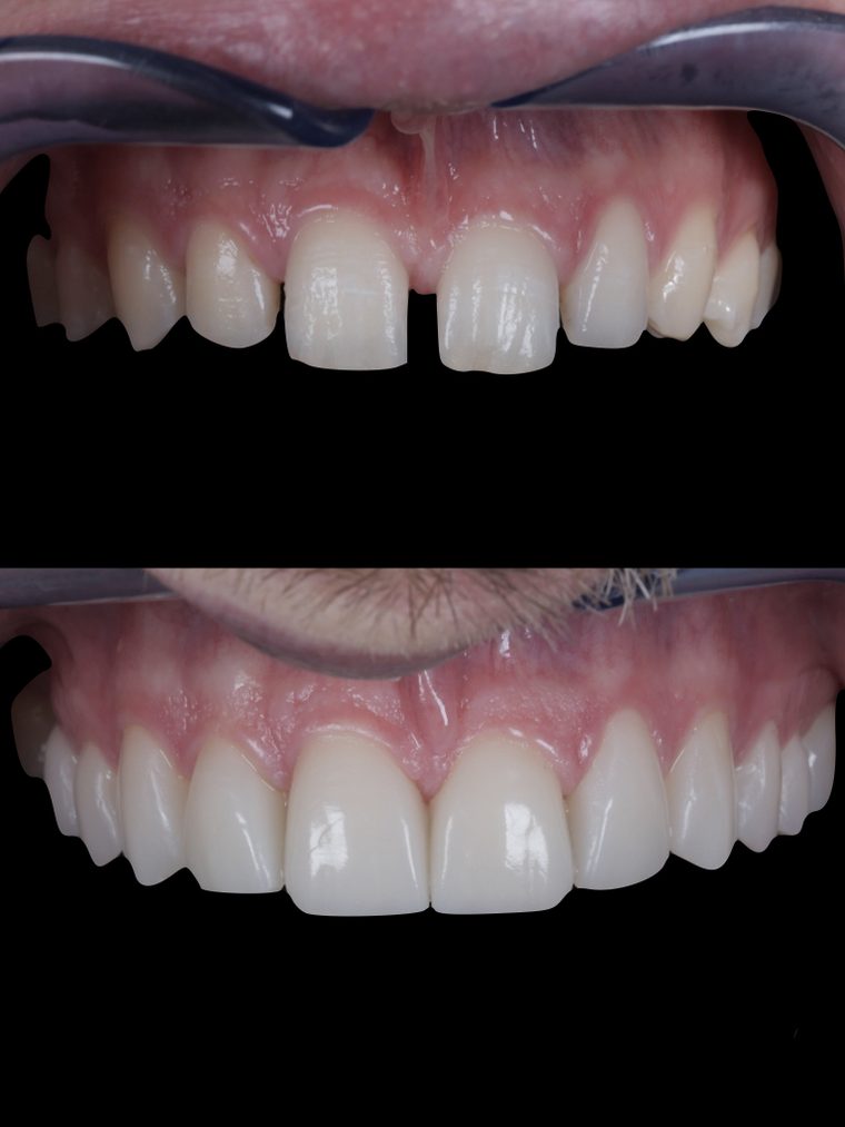 Caso clinico Flow Injection Technique: prima e dopo